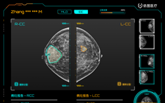乳腺钼靶AI落地临床：1600万像素秒级阅片，水平接近资深医生
